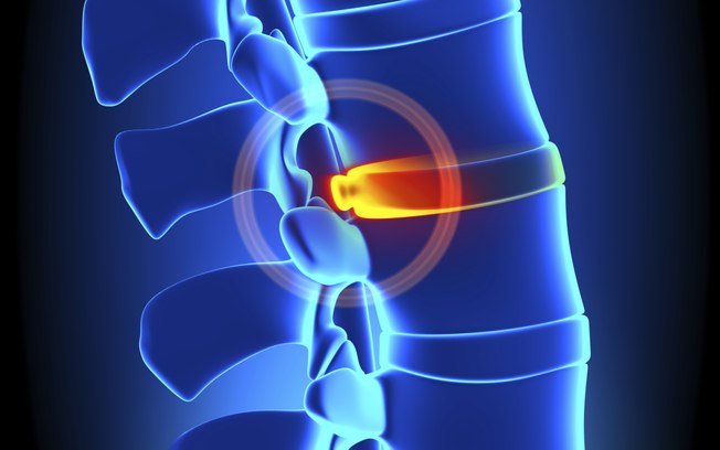 Cirurgia minimamente invasiva da coluna: tudo o que você precisa saber